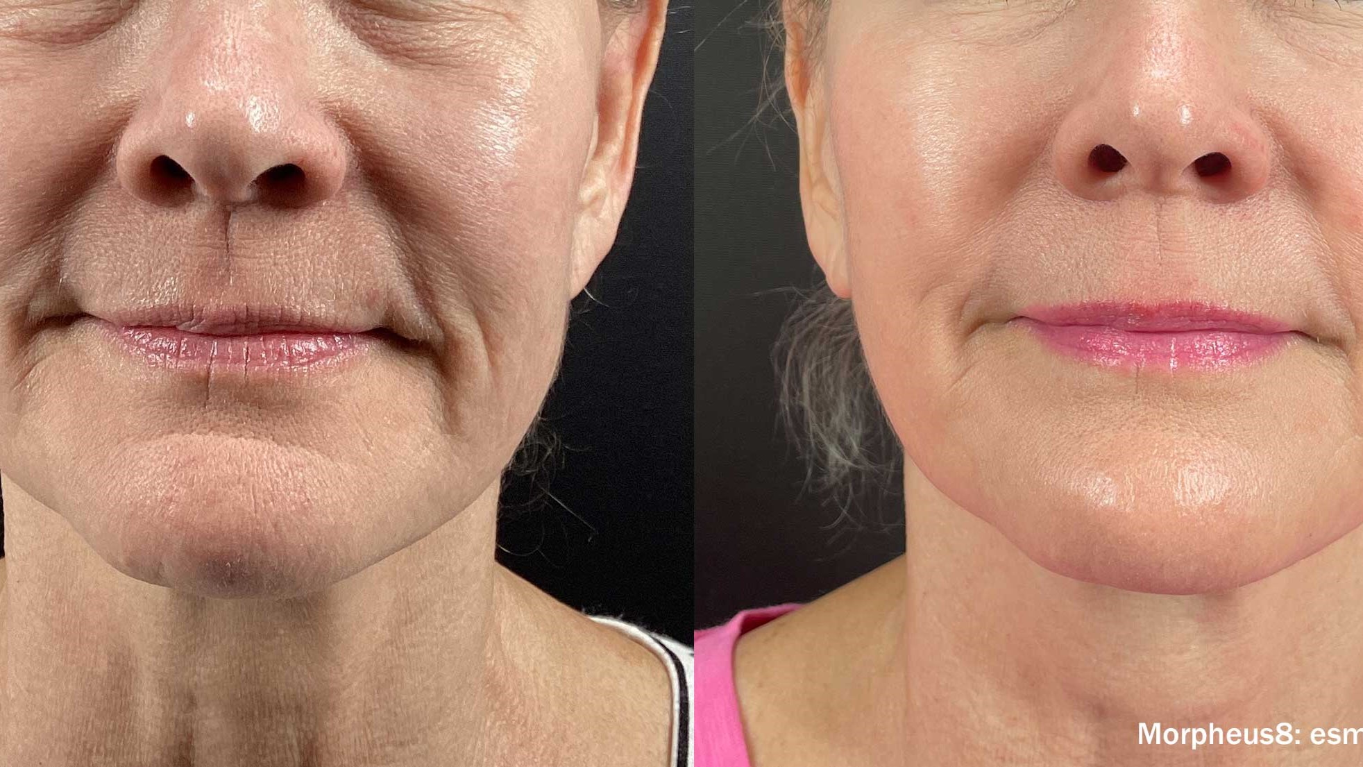 before/after
